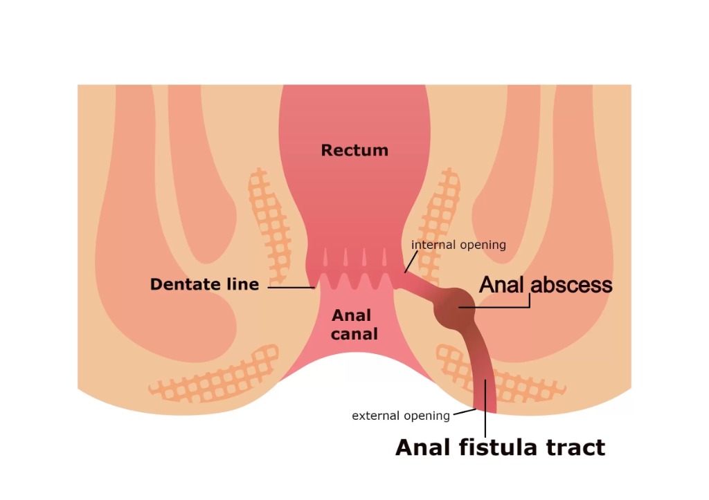 Anal Fistula