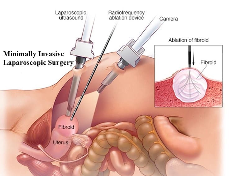 Learn About Bariatric Surgery