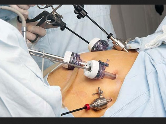 Laparoscopic Surgery